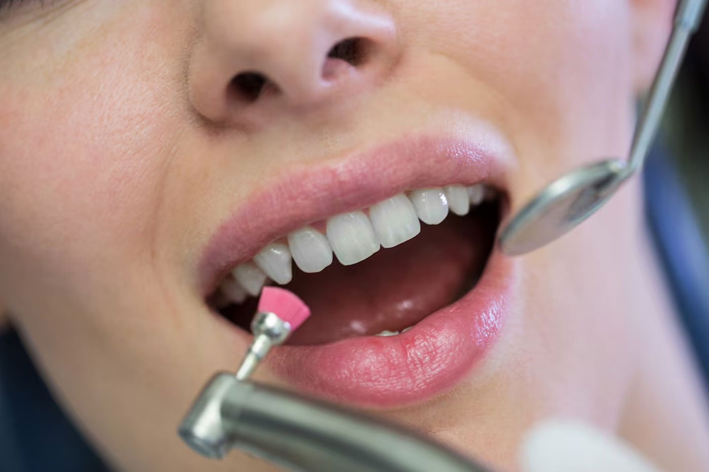 Gum Depigmentation