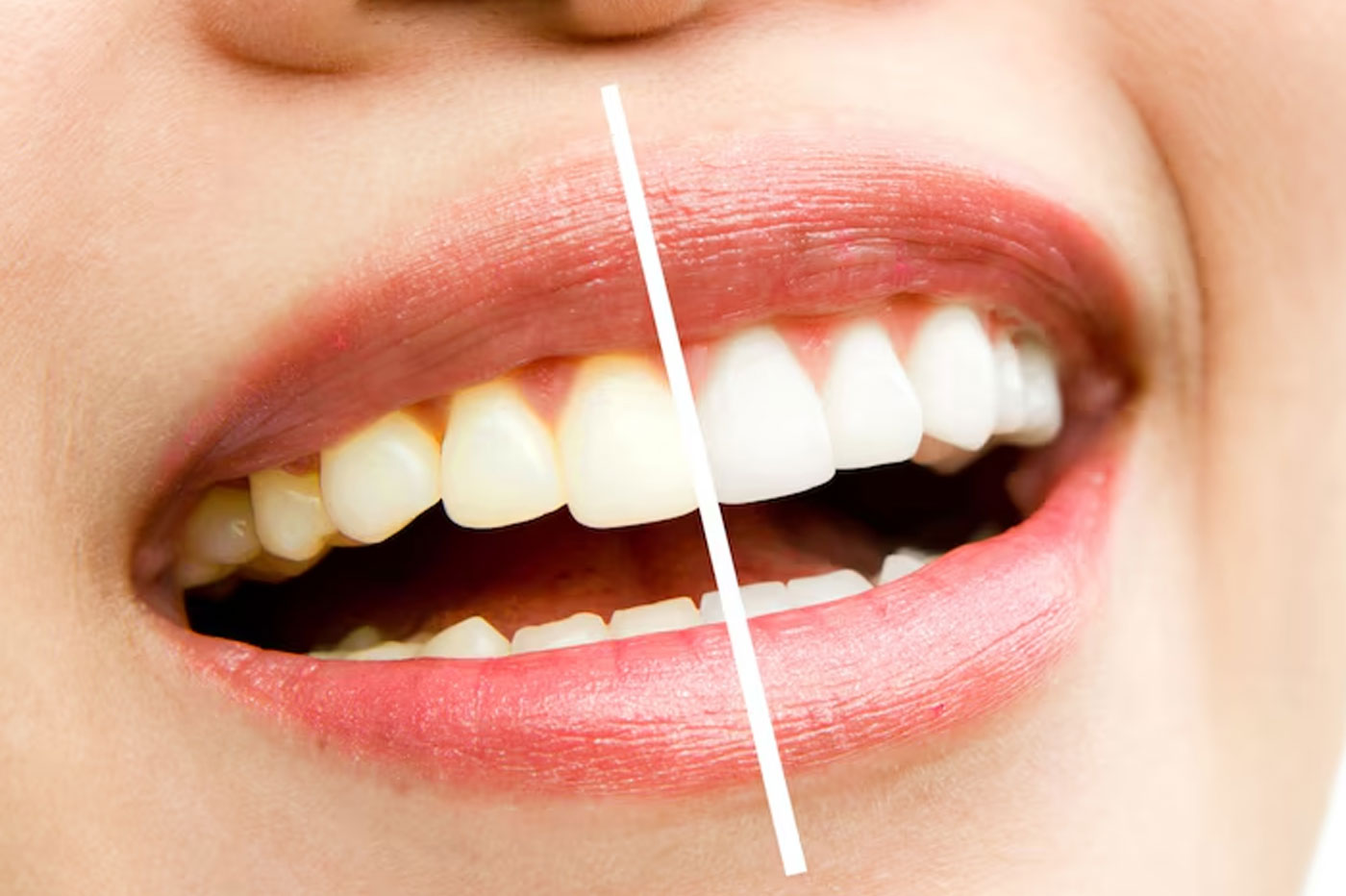 Teeth Whitening