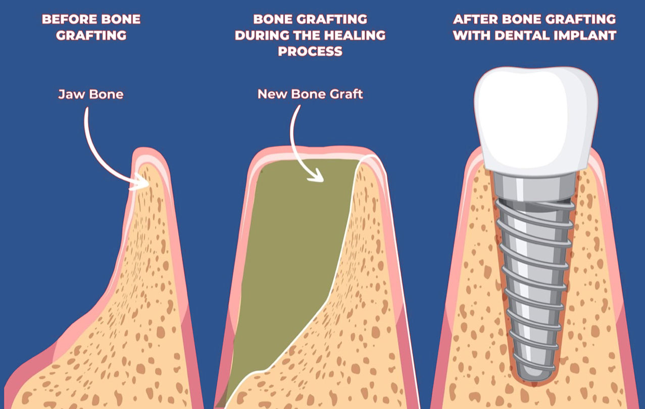 Bone Grafting