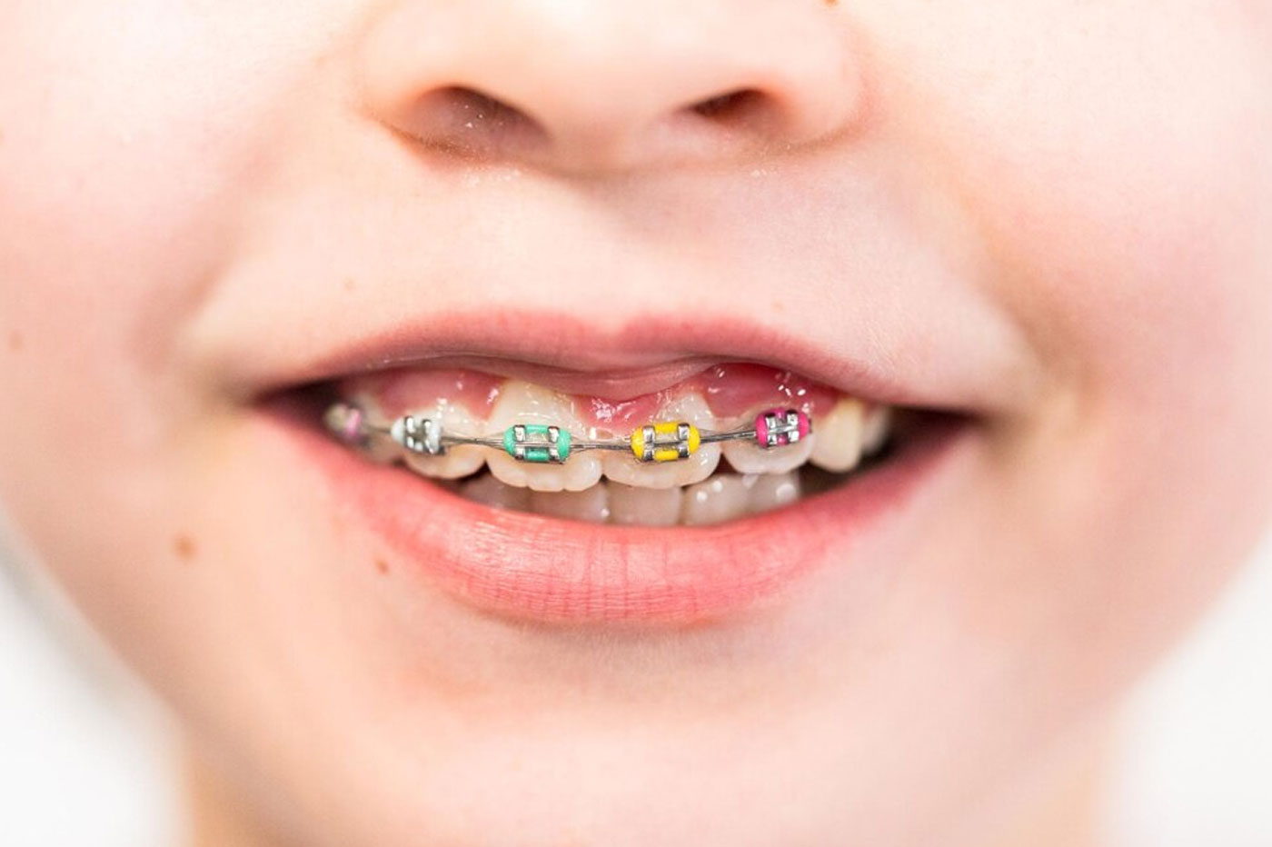 Braces-Metal/Tooth Colored