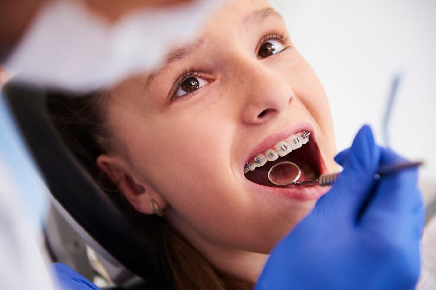 Correction of Protruded Teeth