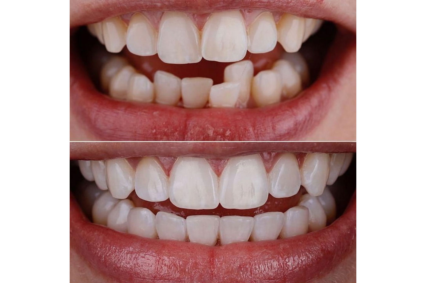 Correction of Spaced and Irregular Teeth