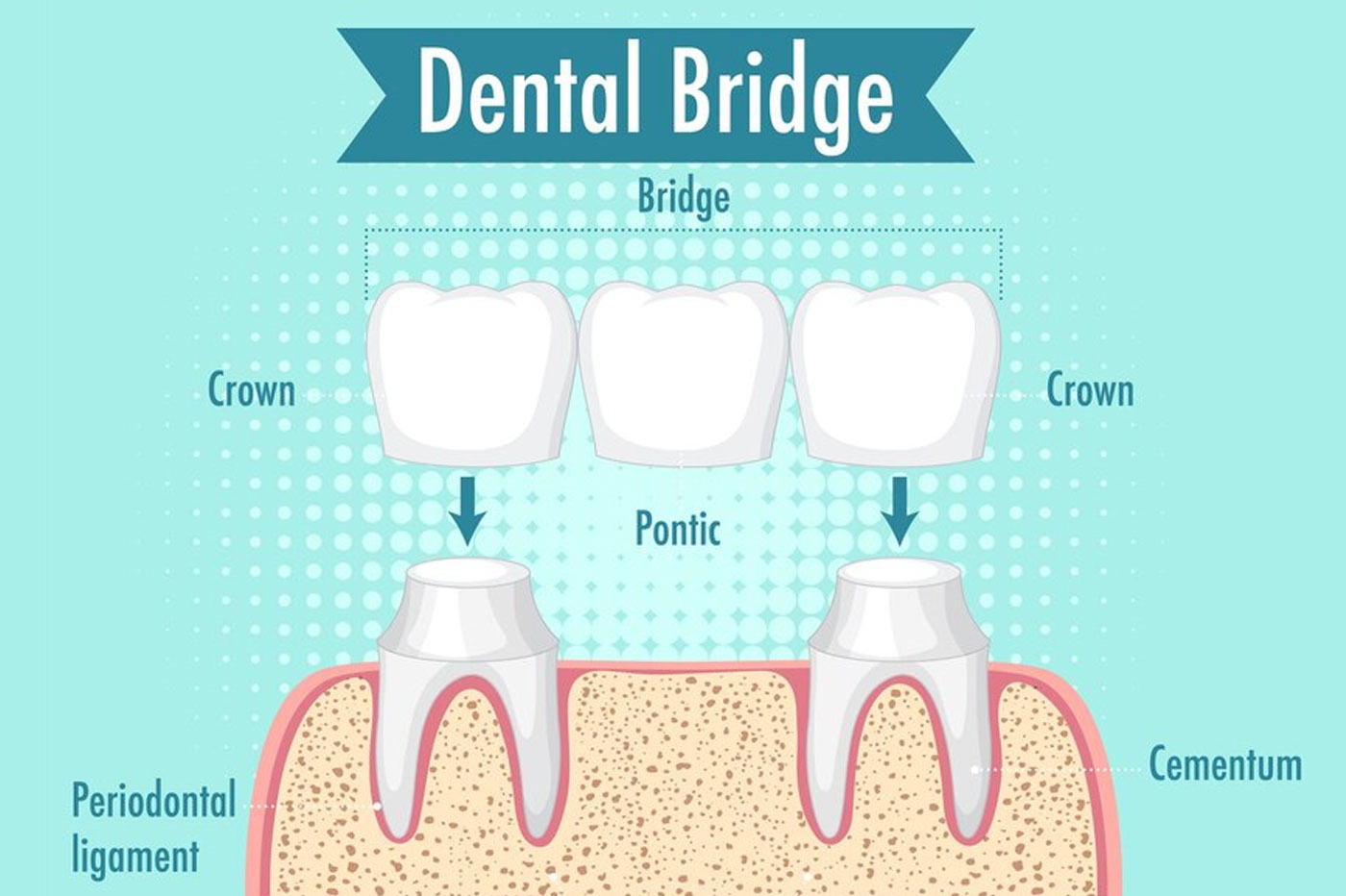 Crown & Bridges