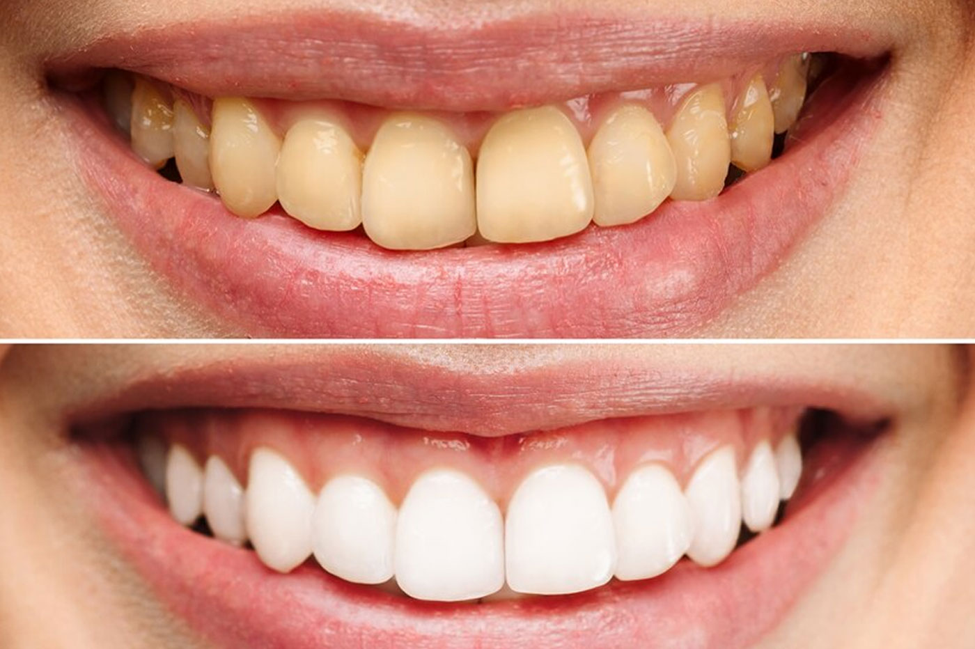Discolored Teeth