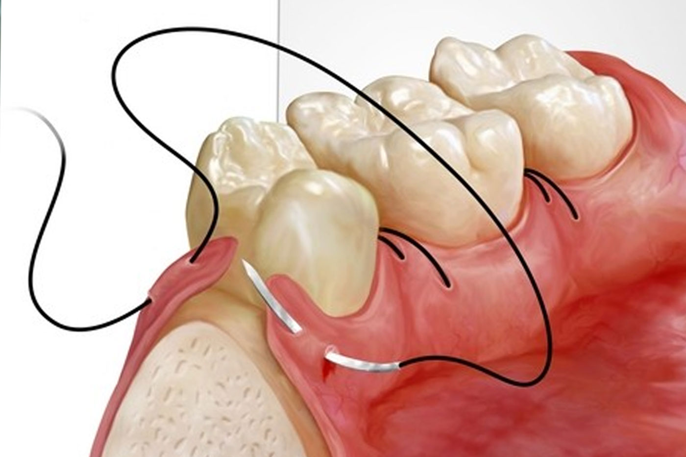 Flap Surgeries