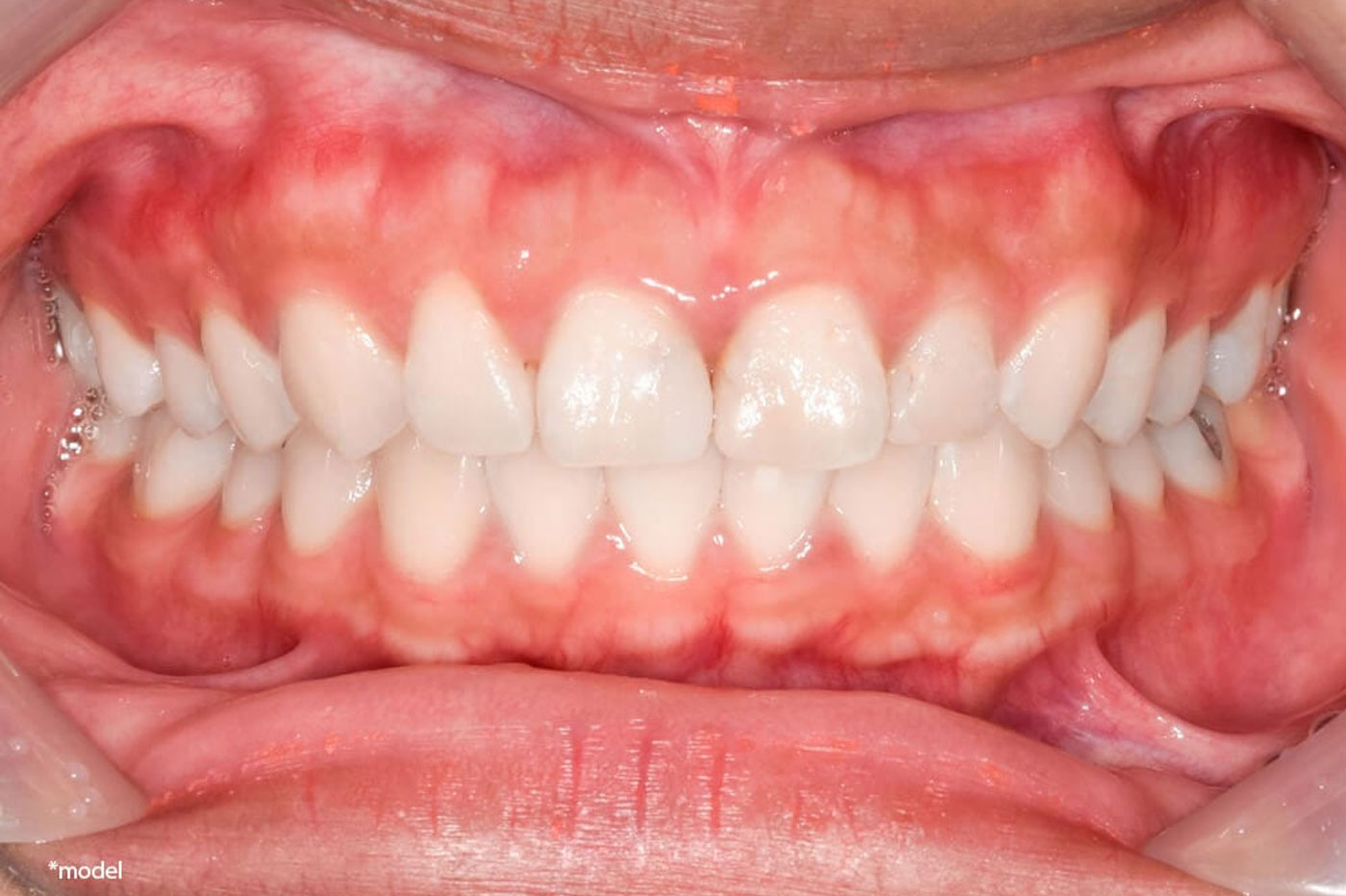 Frenectomy