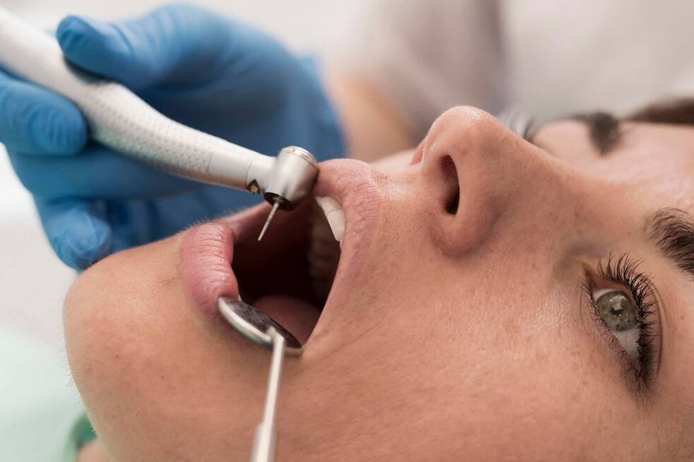 Gingivectomy