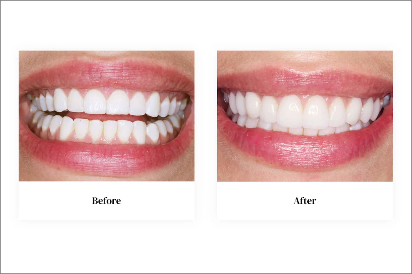 Gum Contouring