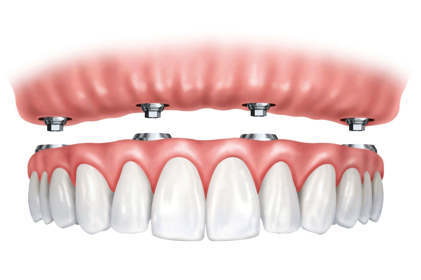 Implant Supported Fixed Dentures