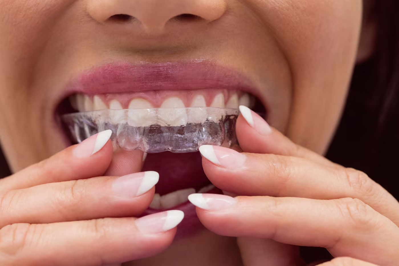 Invisible Braces : Clear aligners, Lingual Braces