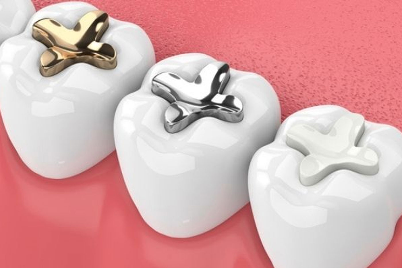 Metal Free Fillings & Restorations