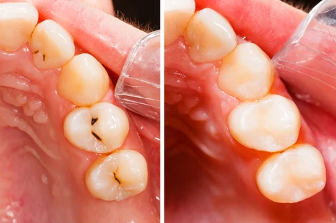 Metal Free Fillings & Restorations