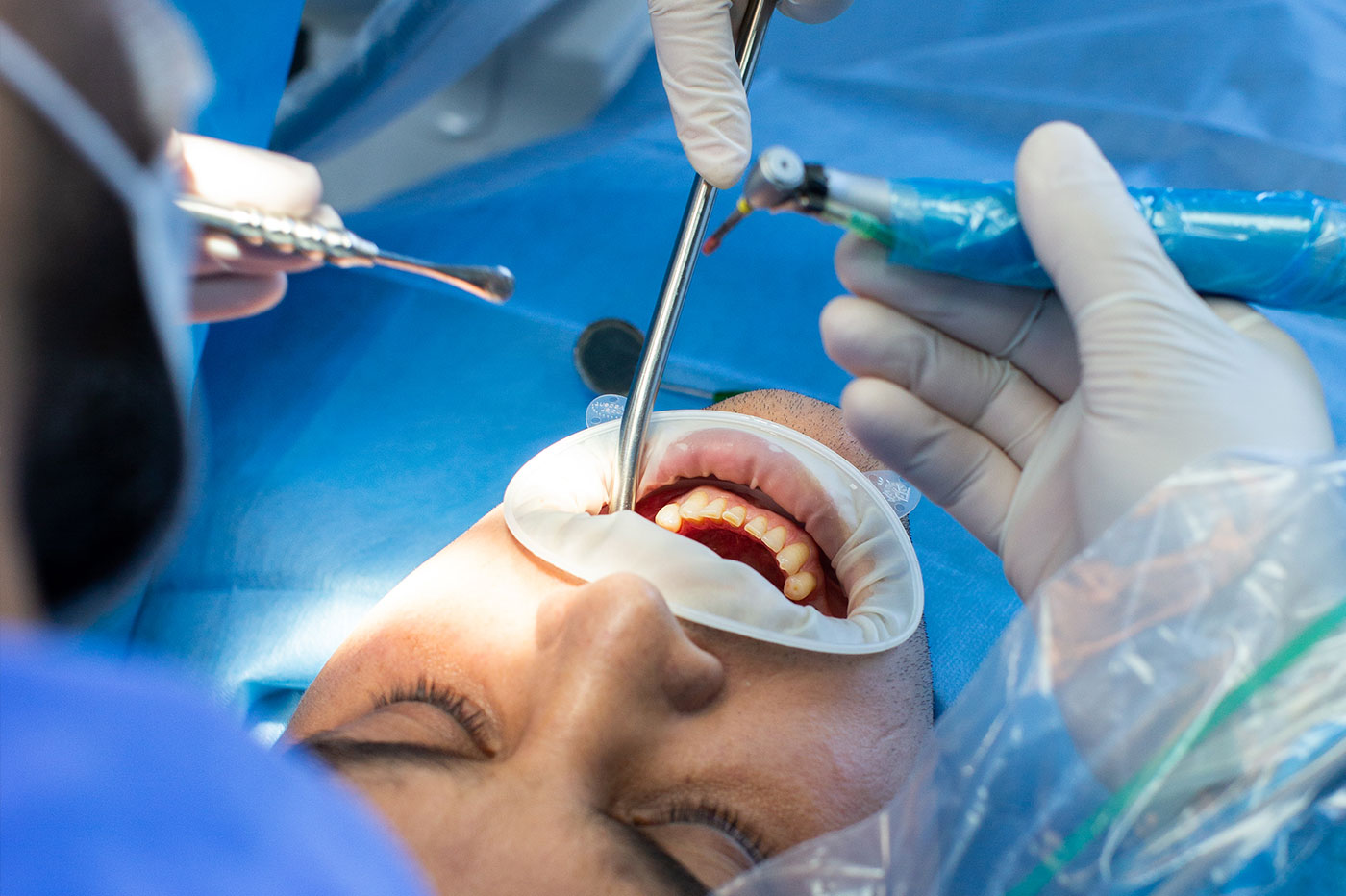 Minor Oral Surgeries