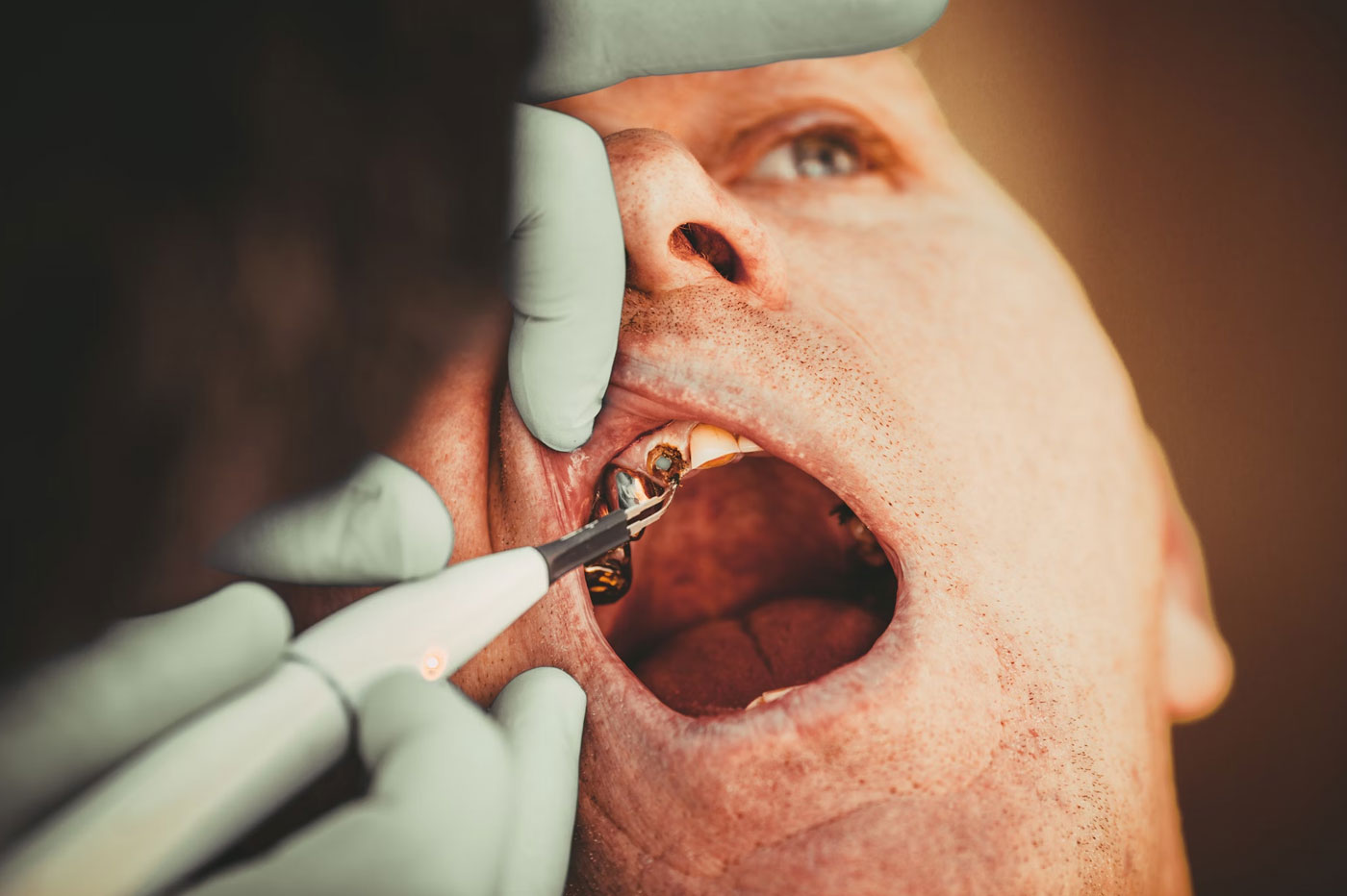 Re-implantation