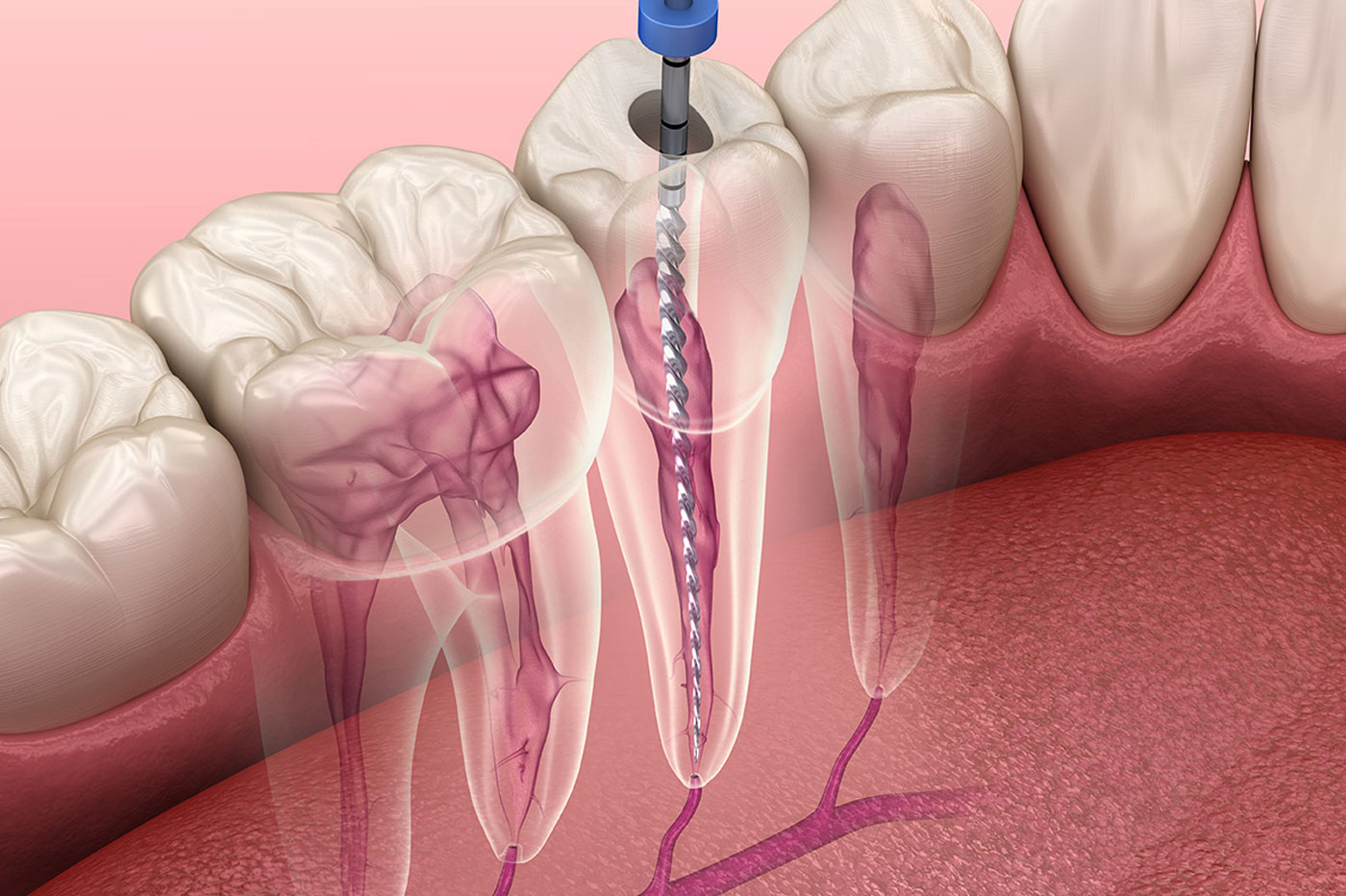 Re-root Canal Treatment