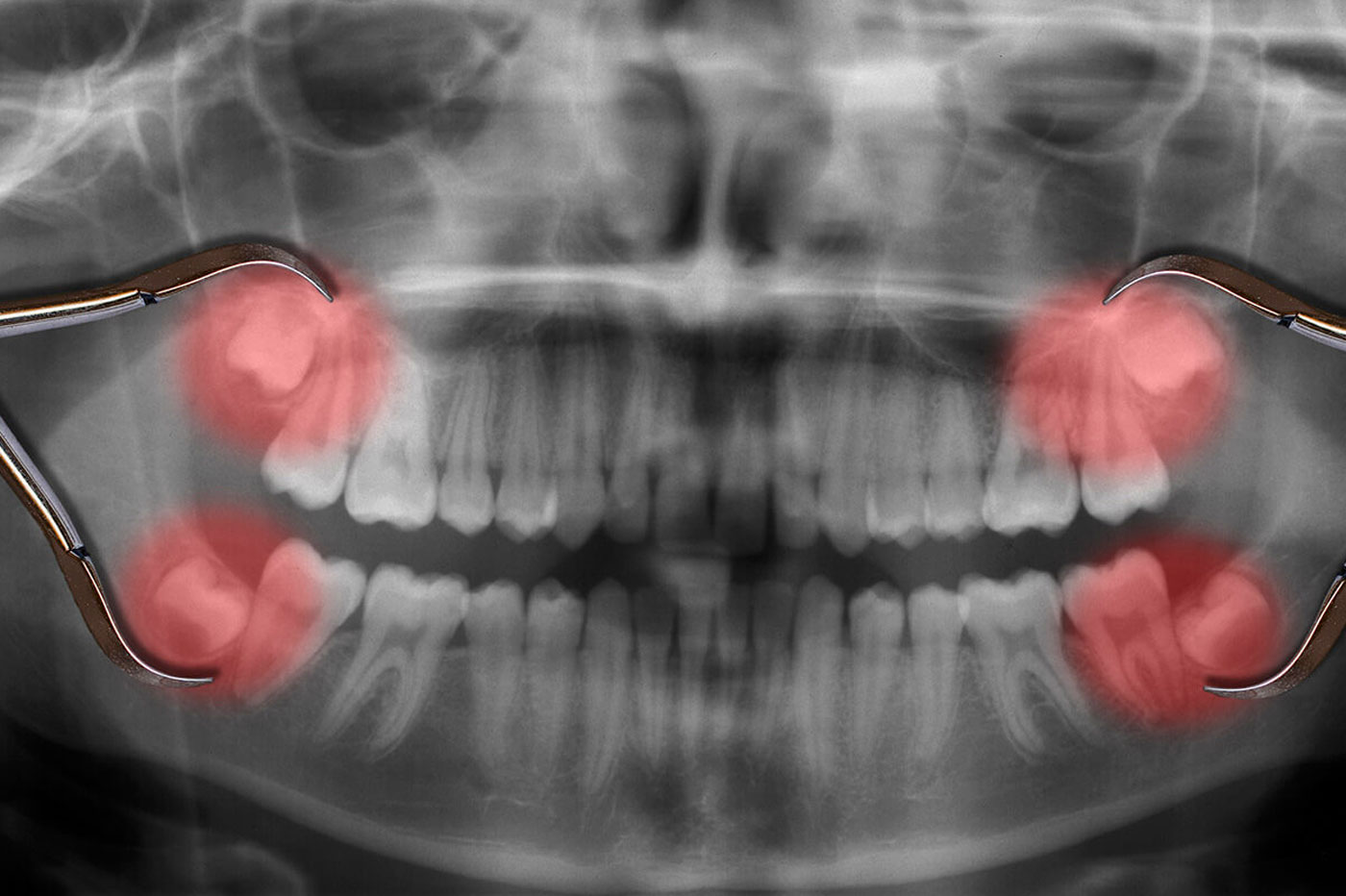 Removal Of Wisdom Tooth
