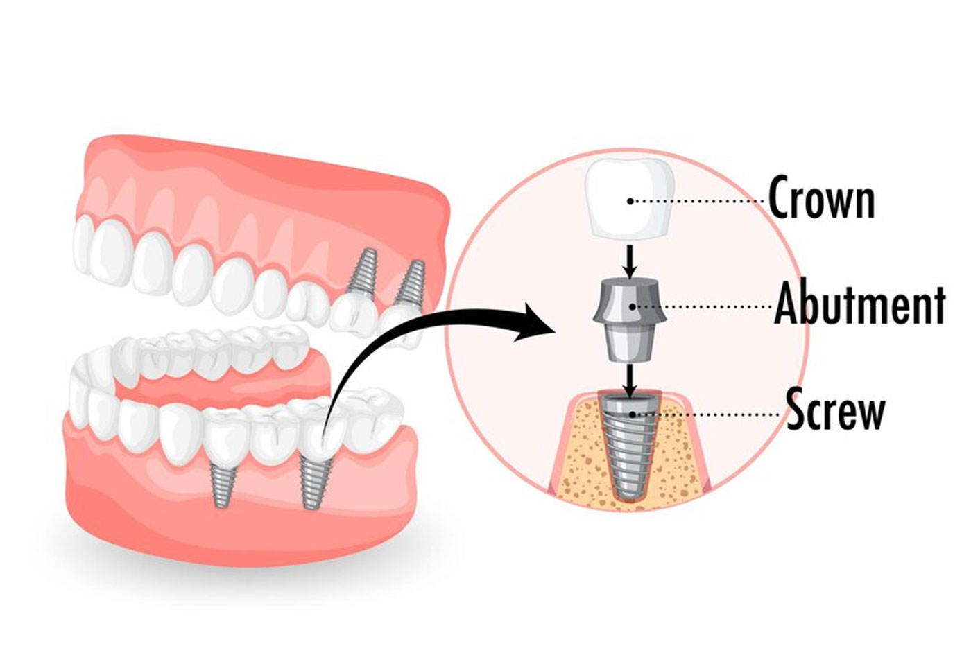 Replacement of single/Multiple Teeth