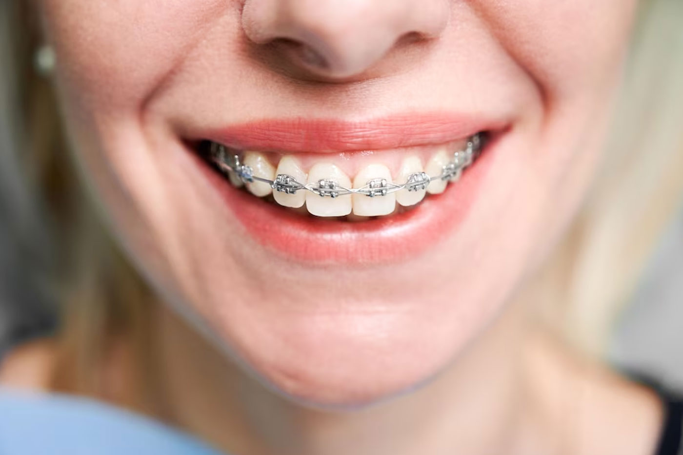 Self Ligating Braces - Metal/ Tooth Coloured