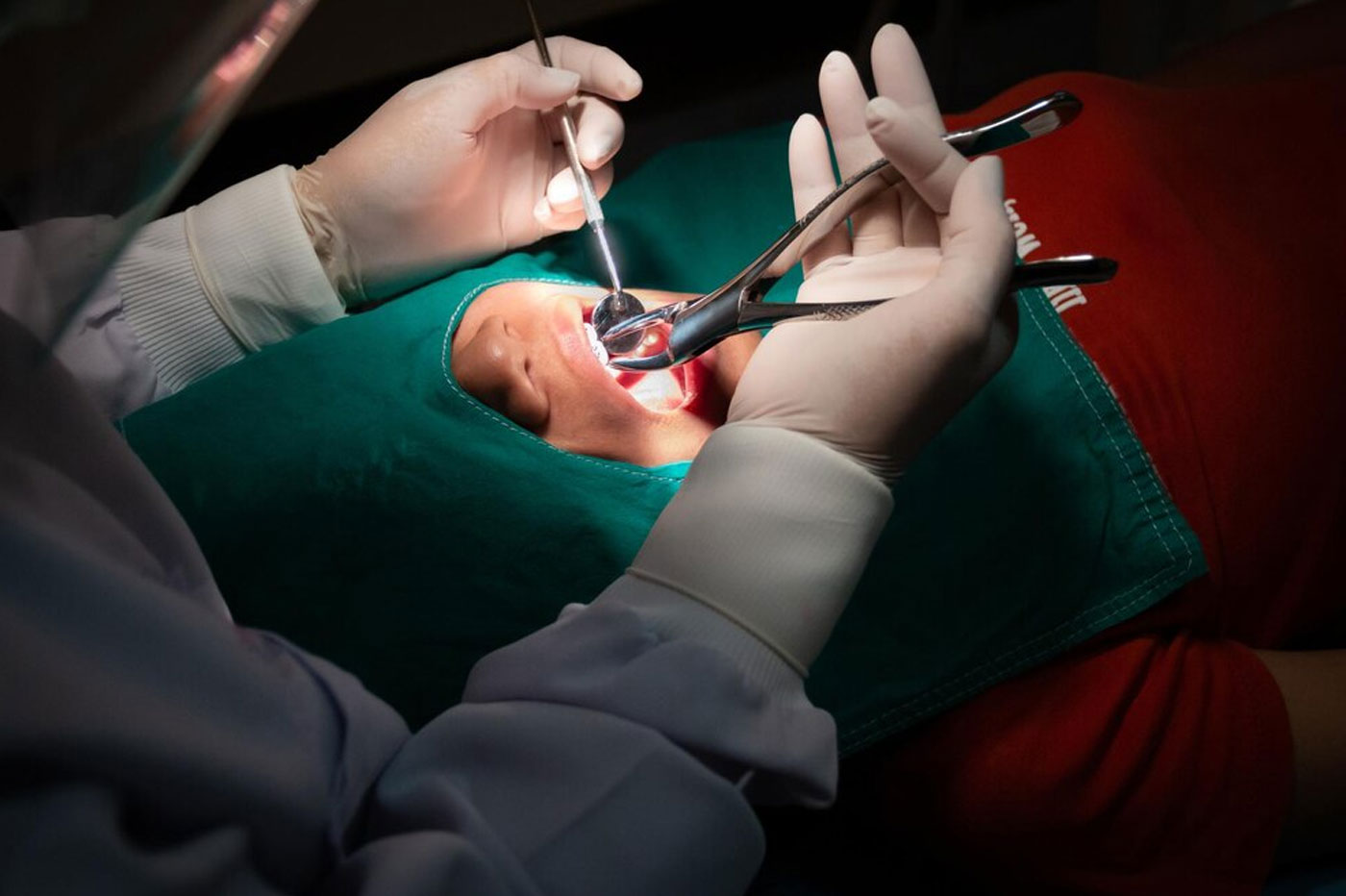Surgical Extractions