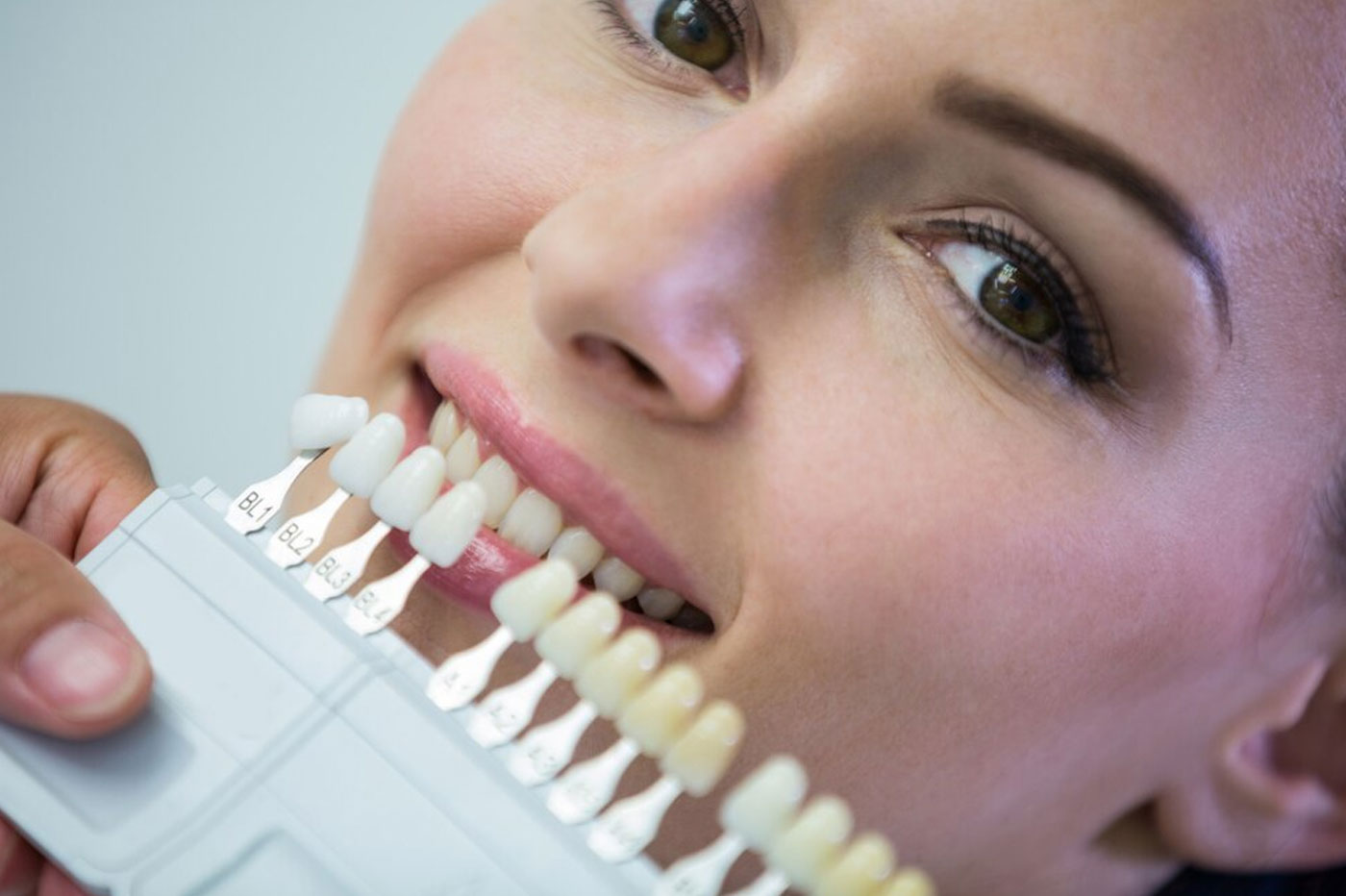Tooth coloured Fillings and Restorations