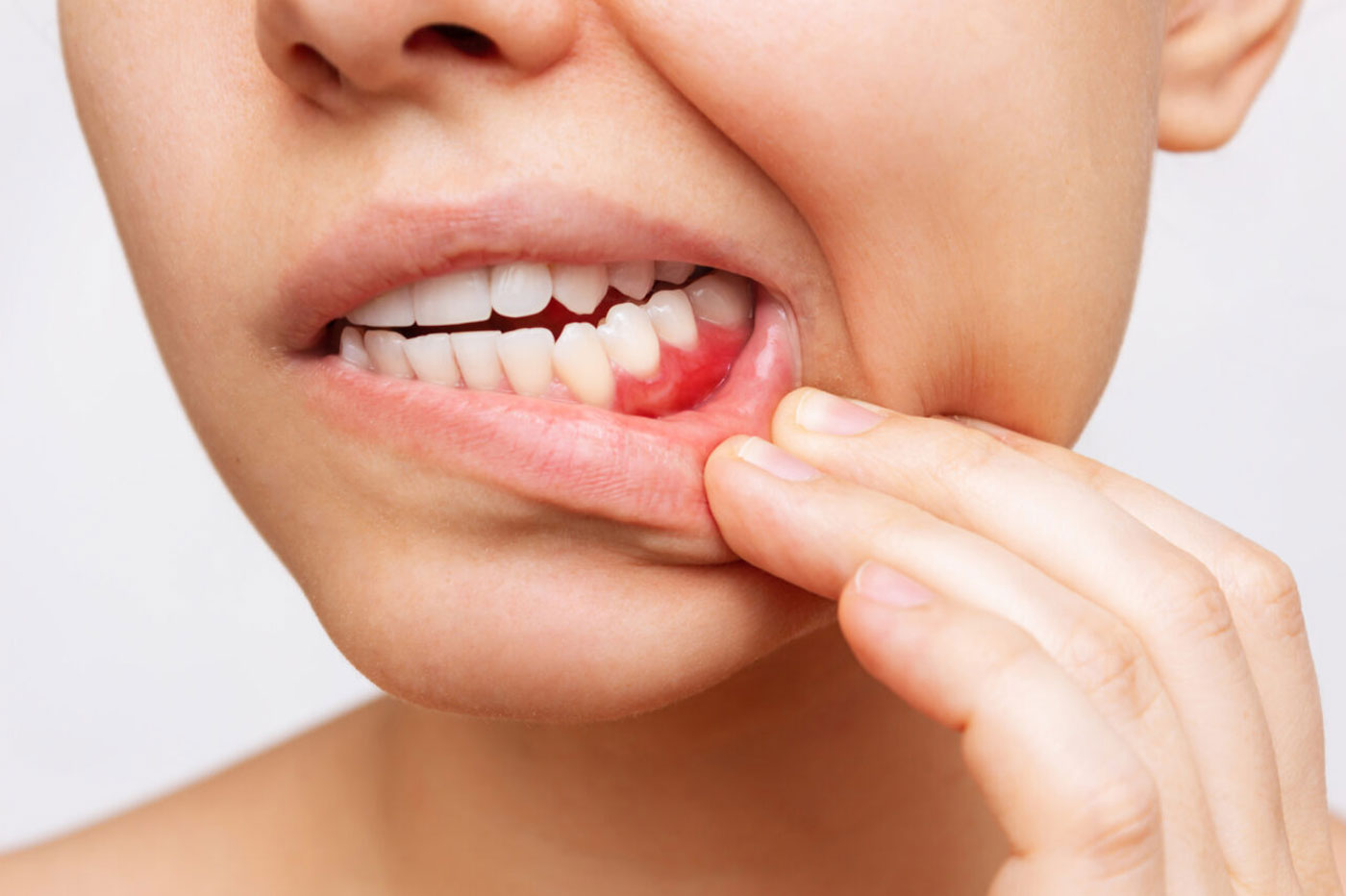 Treatment For Bleeding Gums